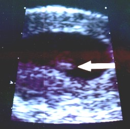 ultrasound7wks.jpg
